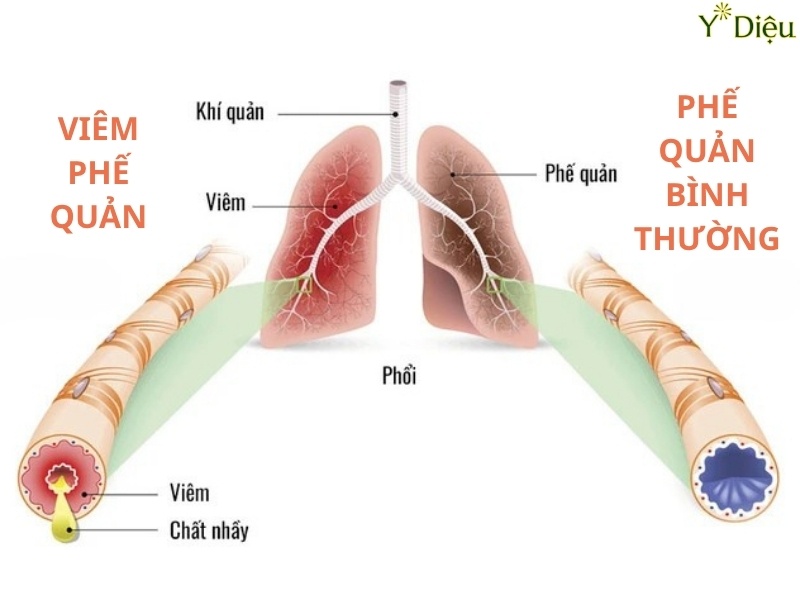 Viêm Phế Quản Mạn Tính: Chuẩn Đoán, Phòng Ngừa Và Điều Trị